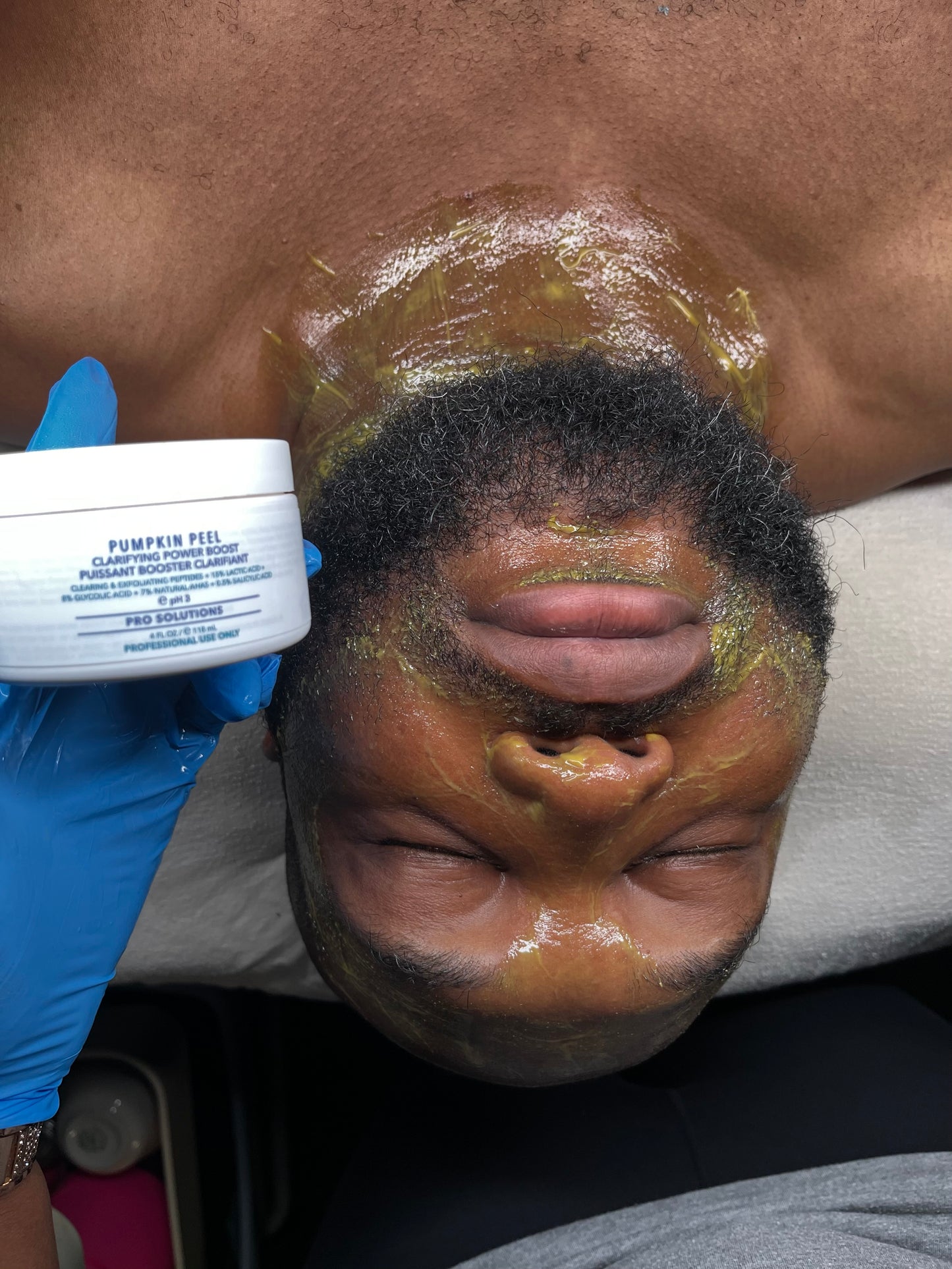 Chemical Peel Treatment