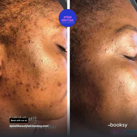 Chemical Peel Treatment