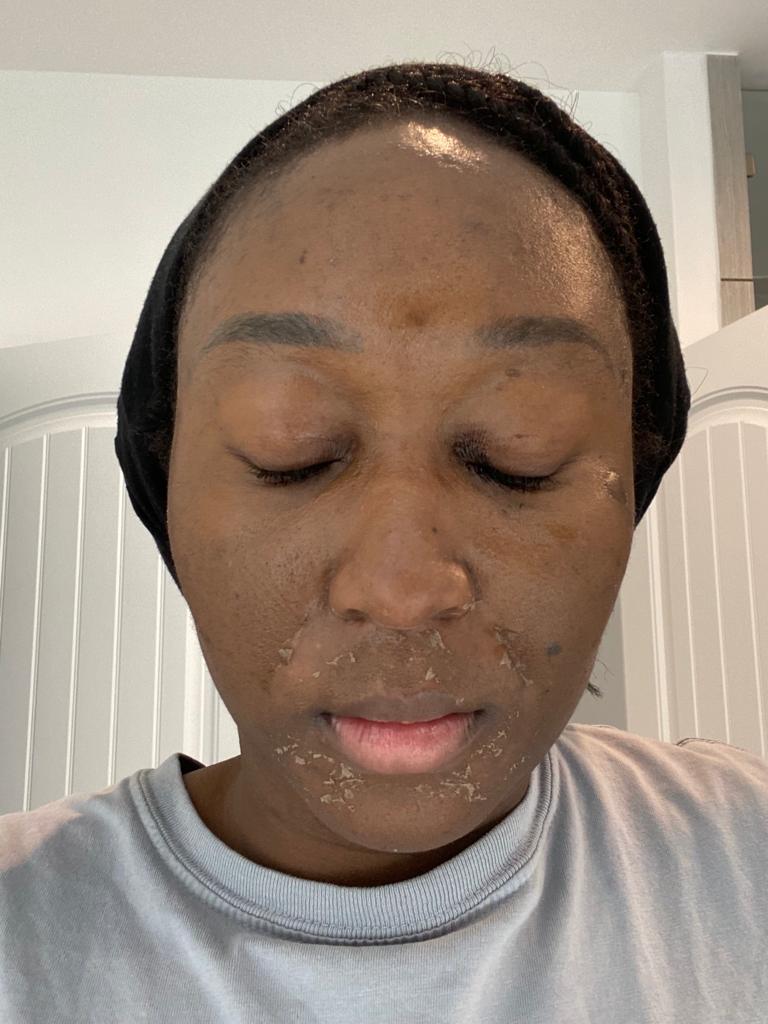 Chemical Peel Treatment