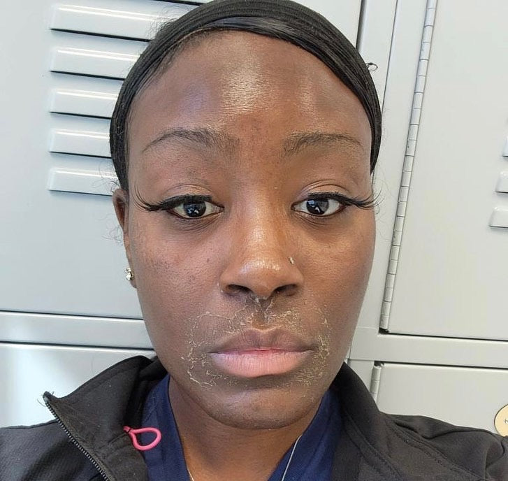 Chemical Peel Treatment