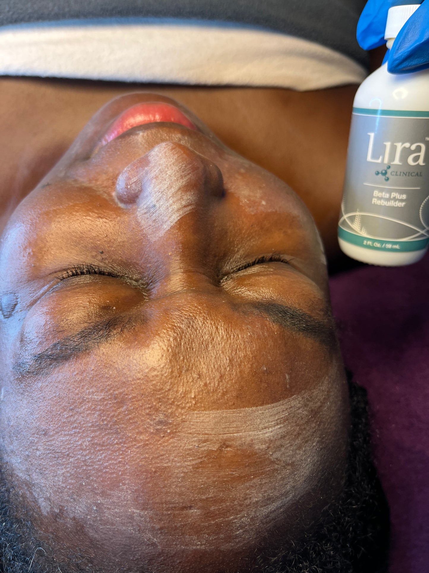 Chemical Peel Treatment