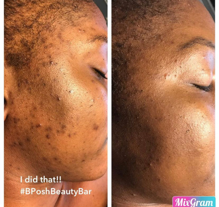 Lira Clinical Acne/Oily Travel + Care Kit