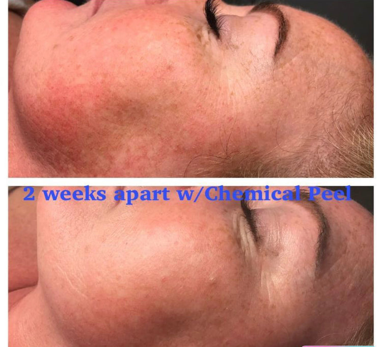 Lira Clinical Acne/Oily Travel + Care Kit