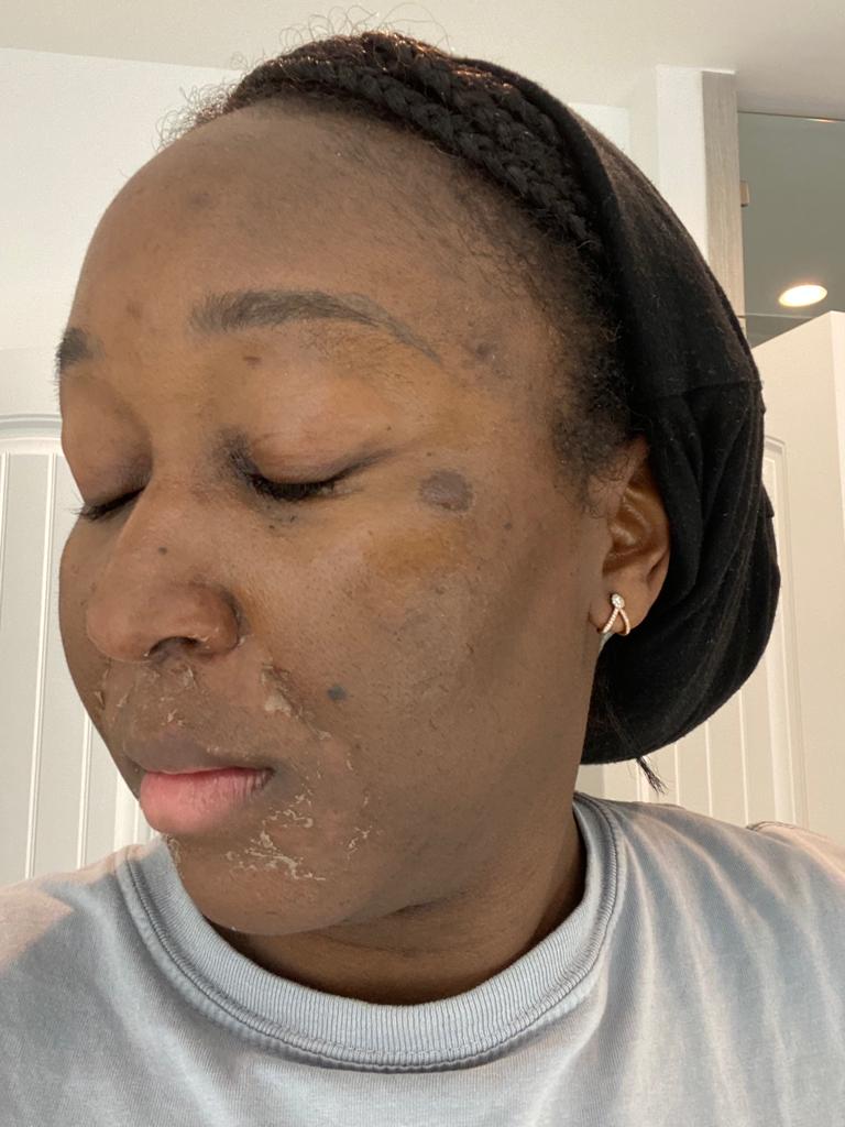 Chemical Peel Treatment
