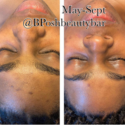 Acne Facial Treatment