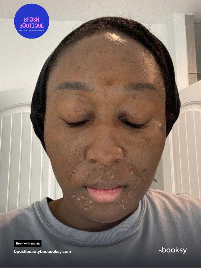Chemical Peel Treatment