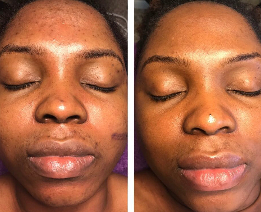 Acne Facial Treatment