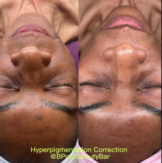 Advanced Brightening Chemical Peel in Katy, TX | Even Skin Tone & Radiant Glow