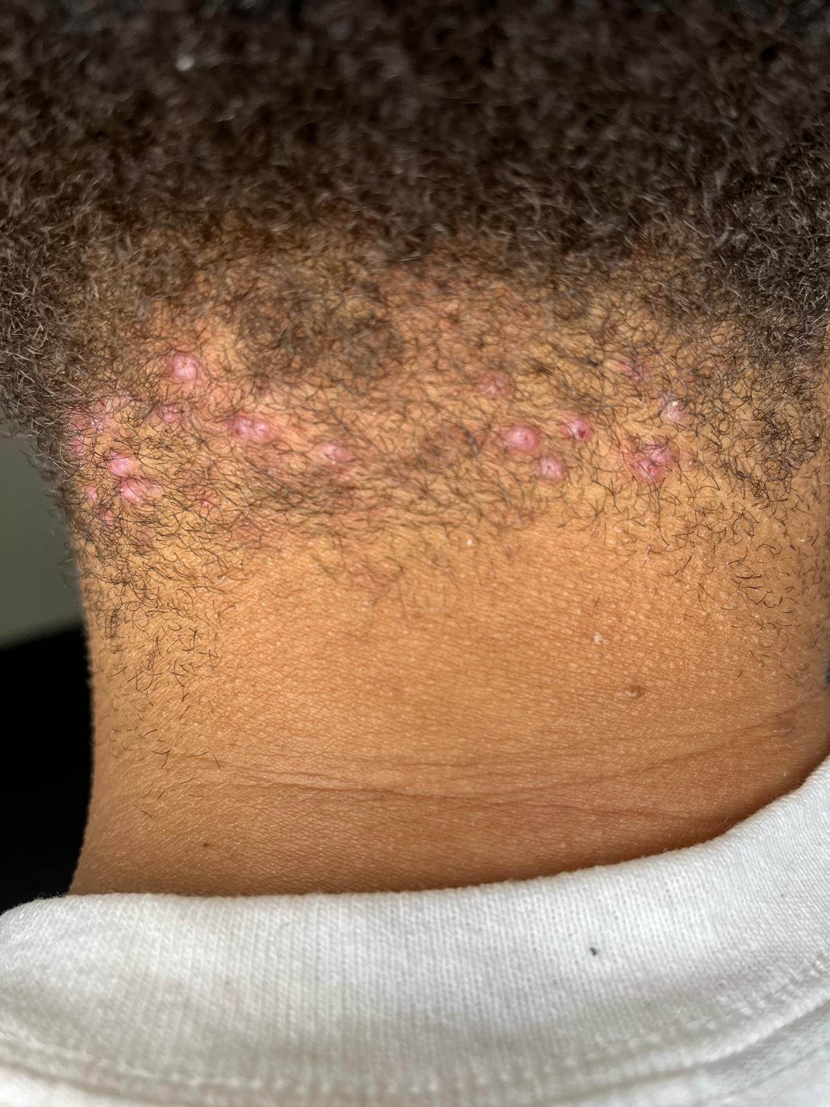 Chin and Neck Waxing