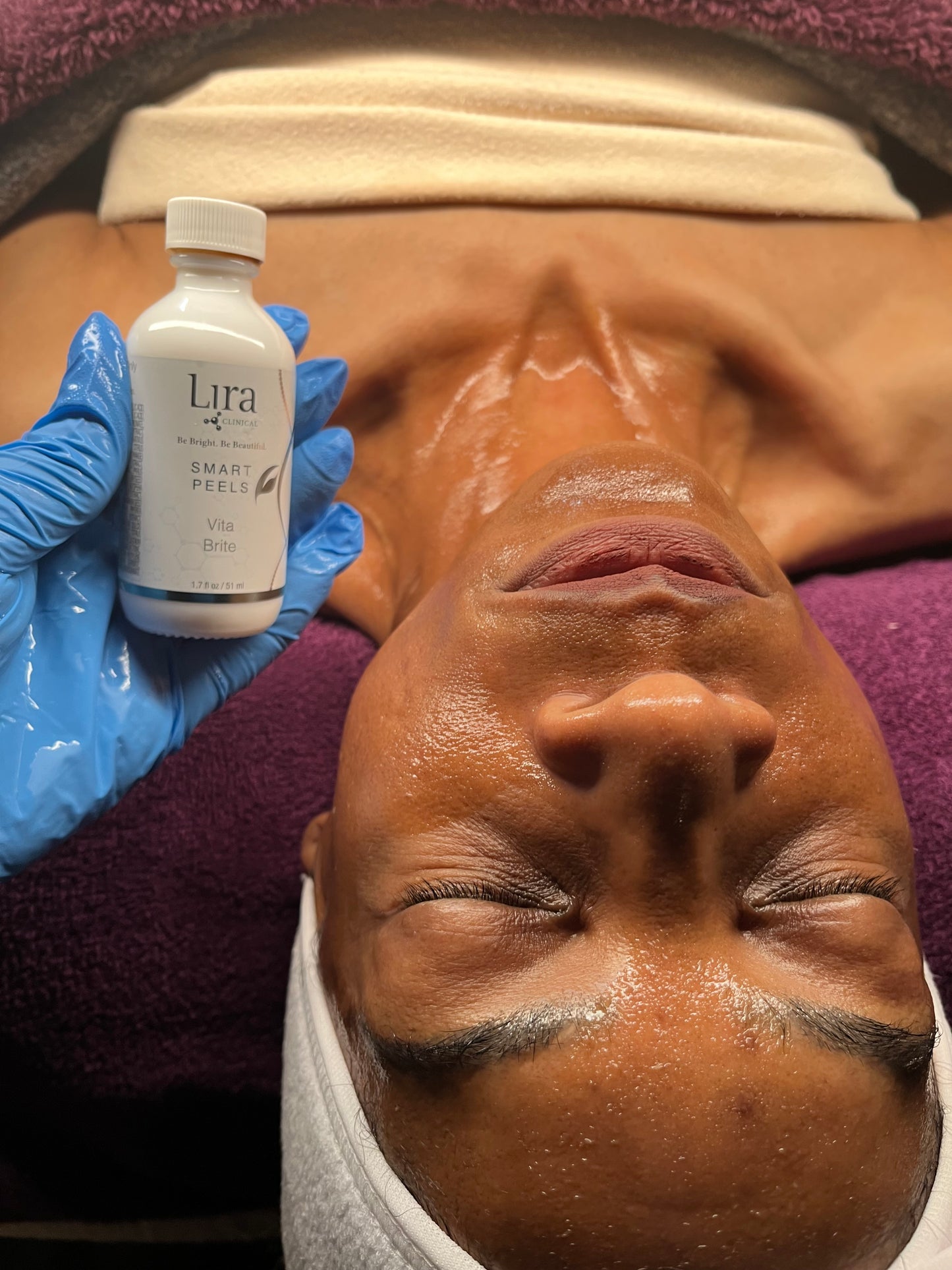 Chemical Peel Treatment