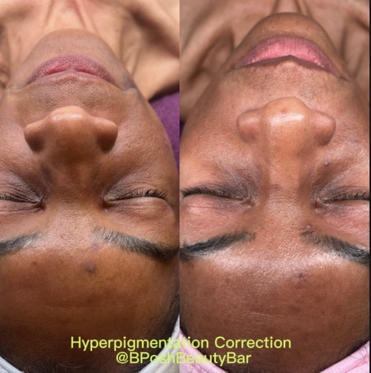 Advanced Brightening Treatment