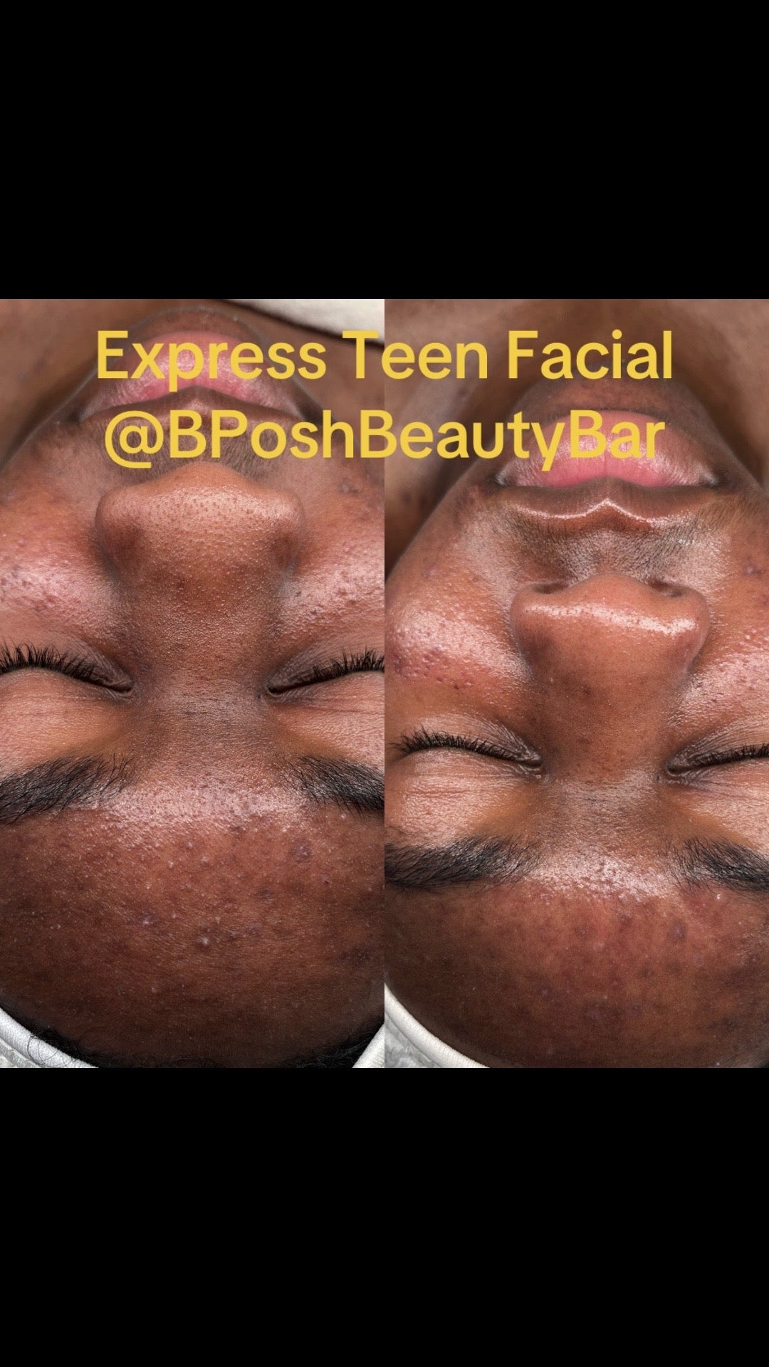 Express Teen Facial